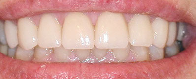 porcelain veneer smile makeover